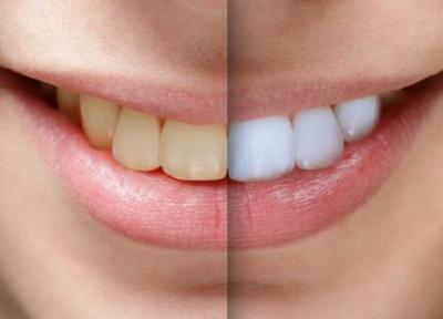 بلیچینگ دندان ضرر هم دارد؟