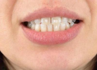 لکه های سفید روی دندان، از علل تا درمان آن
